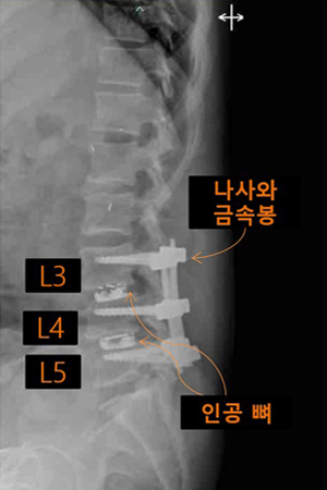 척추내시경 유합술 과정